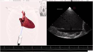 HeartWorks Hypovolemia [upl. by Tyrone183]