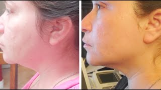 UltraCavitat Review  Get Rid Of Double Chin And Neck Fat In 1 Week With Ultrasonic Cavitation [upl. by Hajidahk]