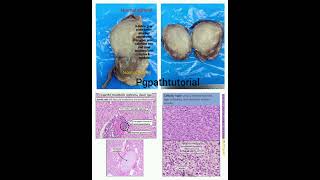 Crisp summary of congenital mesoblastic nephroma a NTRK positive tumor [upl. by Alex]