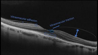 Course in clinical applications of OCT for macular diseases Vitreomacular abnormalities part one [upl. by Eisdnil]