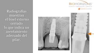 Tecnologia Spiralock BioHorizons [upl. by Enid595]