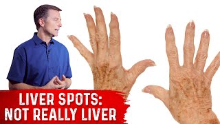 What Causes Liver Spots Age Spots – Dr Berg on Vitamin C Deficiency [upl. by Meijer]