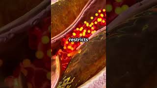 “Atherosclerosis Explained in 50 Seconds”hearthealth wellnesstips medfacts ournursesourfuture [upl. by Hopkins]