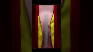 Angioplasty in 3D Watch How It Fixes Heart Blockages [upl. by Yerkovich124]