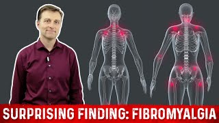 What is Fibromyalgia – Surprising Finding Explained by Dr Berg [upl. by Alliw]