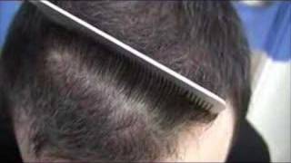 UK Hair Transplant Call 07578164162 [upl. by Carroll]