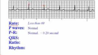 ECG Sinus Bradycardia [upl. by Hpseoj633]