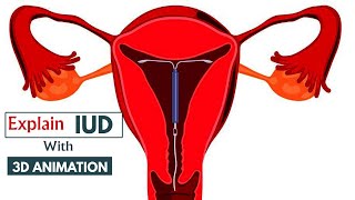 How does an IUD work  Understanding IUDs  Animated Guide  3D animation [upl. by Abie]