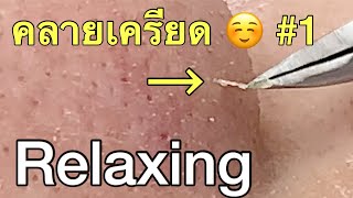 กดสิว blackheads filaments on nose remove with tweezers [upl. by Laban]