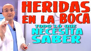 HERIDAS EN LA BOCA AFTAS ORALES  Todo lo que necesita saber  Enfermedades 10 [upl. by Yetah]