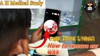 How to remove ear wax camera endscope [upl. by Ofelia]