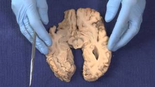 Basal Ganglia Neuroanatomy Video Lab  Brain Dissections [upl. by Tarrah]