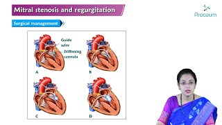 Mitral Stenosis amp Mitral Regurgitation Hindi  Internal Medicine🫀🫀🫀 [upl. by Treble]