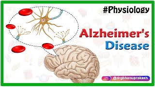 Alzheimers disease  Etiology Pathophysiology Signs and symptoms Diagnosis and Treatment [upl. by Haidedej]