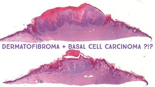 Dermatofibroma  TRUE basal cell carcinoma  basaloid hair follicle induction Emory case 5 [upl. by Annav]