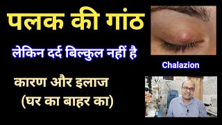 पलक में गांठ  कारण  इलाज  घर का बाहर का  Home Remedies Chalazion [upl. by Ahsemaj545]