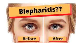 Blepharitis How to treat Blepharitis Best Home Treatment [upl. by Aelahs]