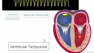 ECG Rhythm Review Ventricular Tachycardia Torsades de points Asystole [upl. by Owen]