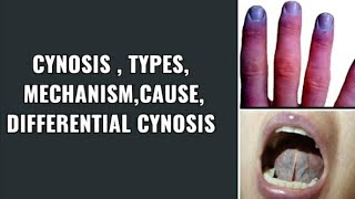 Cyanosis  General Examination  clinical practice Pathology  Online classes for medical students [upl. by Attey]