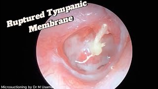 Suppurative Otitis media With No Tympanic Membrane [upl. by Araf476]