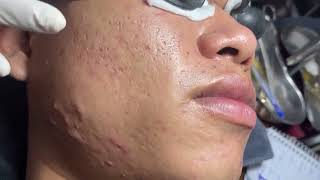 Acne Treatment Huong Da Nang601  2024 blackheads [upl. by Miru]