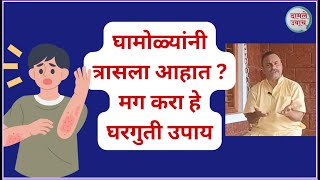 घामोळ्यांनी त्रासला आहात करा हे घरगुती उपाय  How to Get Rid of Heat Rash  Treatment Ghamolya [upl. by Jar]