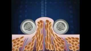 How Endermologie® works lipomassage [upl. by Treat]