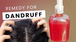 How to get rid of Dandruff with Simple Home RemedyBeginner Tips [upl. by Aniretake]