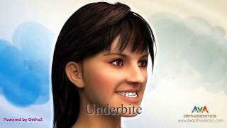 Malocclusion  Different Types [upl. by Ut]