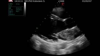 Echocardiogram of left atrial myxoma [upl. by Eiznekcm]