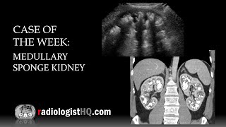 Case of the Week Medullary Sponge Kidney Ultrasound amp CT [upl. by Harshman]