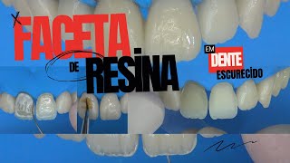 Faceta de Resina Composta em Dente Escurecido [upl. by Losyram846]