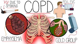 Understanding Chronic Obstructive Pulmonary Disease COPD Explained Clearly [upl. by Dublin]