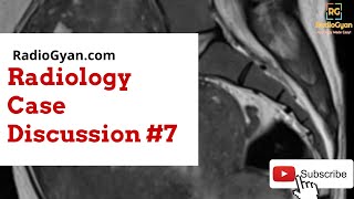 Adenomyosis  Imaging approach Case based  Radiology Board Review Case [upl. by Dirgni474]