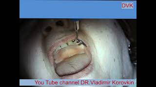 Infiltration Anesthesia for treatment 22 tooth [upl. by Selmner]