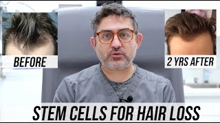 STEM CELL Hair Restorations 2 Year Updates Multiple Patient Success Stories [upl. by Ettelloc]