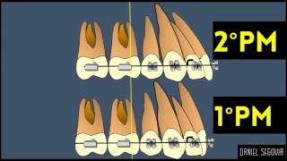 Extracción de segundos premolares en ortodoncia [upl. by Esertap898]