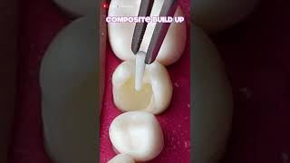 Onlay Teeth Restoration dentistteeth satisfying [upl. by Htezzil]