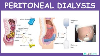 Peritoneal Dialysis Introduction Physiology Technique Modes and Complications [upl. by Arther]