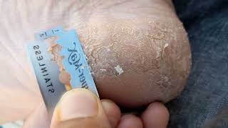 Removing Calluses At Home  Do Thiscallusremoval balckheadremove shorts youtubevideo [upl. by Claribel]