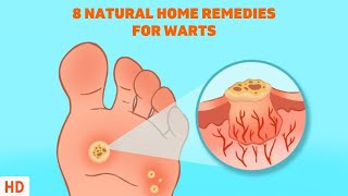 8 Surprising Home Remedies for Warts  Get Rid of Them Naturally [upl. by Enoved945]