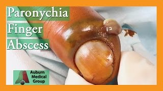 Paronychia Fingernail Abscess Infection Treatment  Auburn Medical Group [upl. by Thurston495]