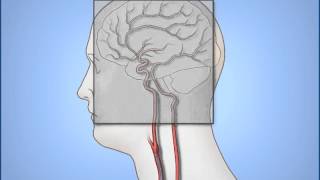 Diagnostic Cerebral Angiography [upl. by Frierson48]