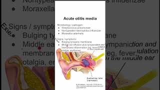 Acute otitis media [upl. by Dnaletak230]