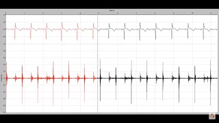 Systolic murmur in mitral regurgitation [upl. by Namyh]