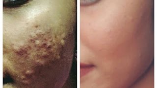 how to get rid of pimpleacnerashes over night remove pimples in 5 hours [upl. by Aynotel]