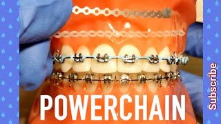 Power Chain on Braces How Painful Is It Orthodontist Explains All You Need To Know [upl. by Niwdog614]