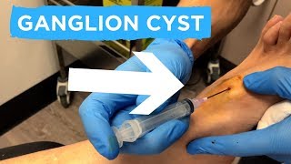 A GANGLION CYST ASPIRATION [upl. by Ecirpac760]