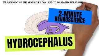 2Minute Neuroscience Hydrocephalus [upl. by Pablo]