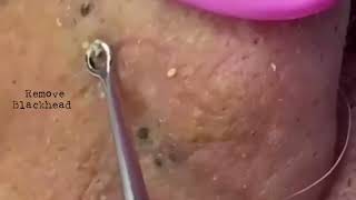 Acne Removal Remove blackhead on his lips noses removeblackhead [upl. by Epuladaug]